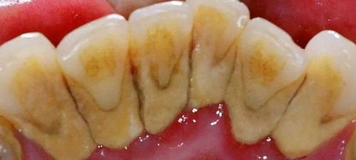 沖牙器有害論？破除2019年口腔衛生用品的誤區