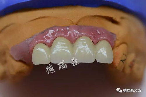 種植牙與口腔衛生用品 長期使用的關鍵